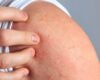 Dermatitis Atópica: la padecen entre un 15 y 30% de niños y niñas