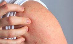 Dermatitis Atópica: la padecen entre un 15 y 30% de niños y niñas
